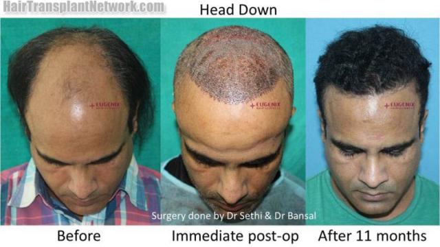 Hair transplantation surgery before and after images