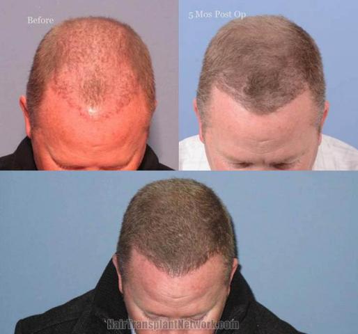 Hair restoration surgery before and after photos