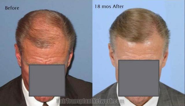 Hair restoration procedure results