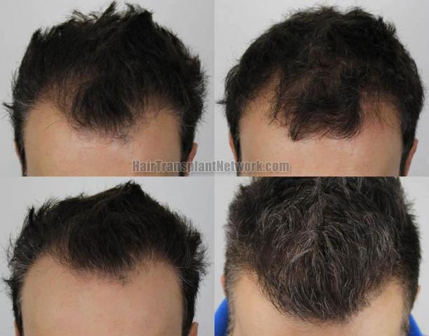 Hair restoration procedure before and after results