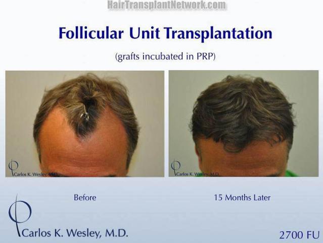 Top view before and after hair restoration results