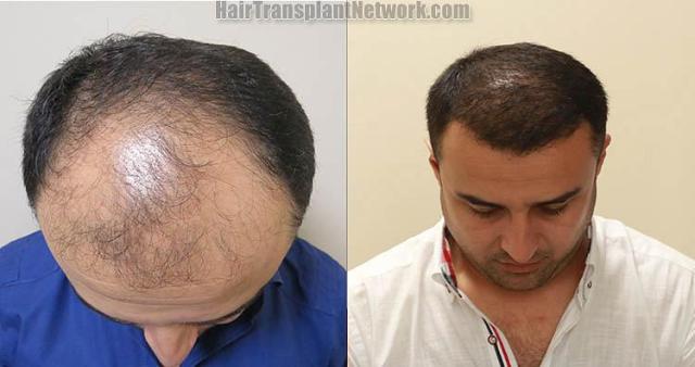 Hair restoration procedure before and after pictures