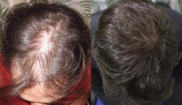 Hair transplantation surgery before and after images