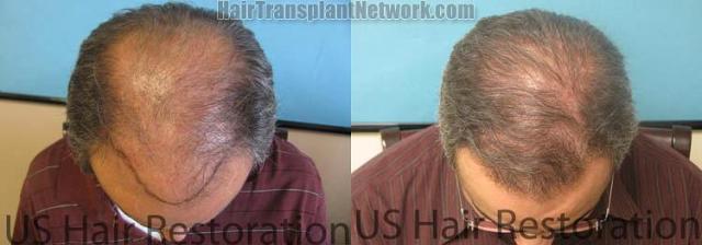 Top view - Before and after surgical hair replacement