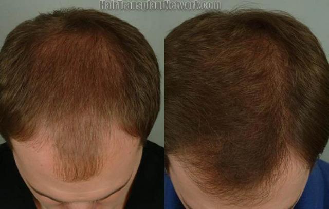 Hair transplantation surgery before and after images