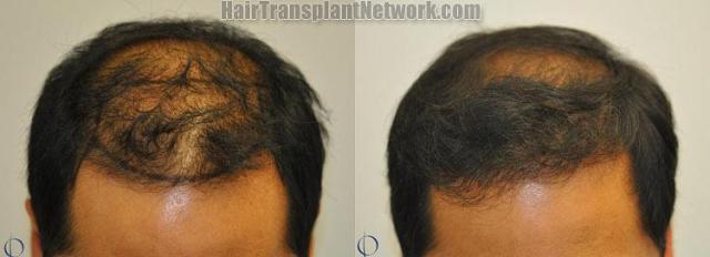 Hair transplantation surgery before and after photos