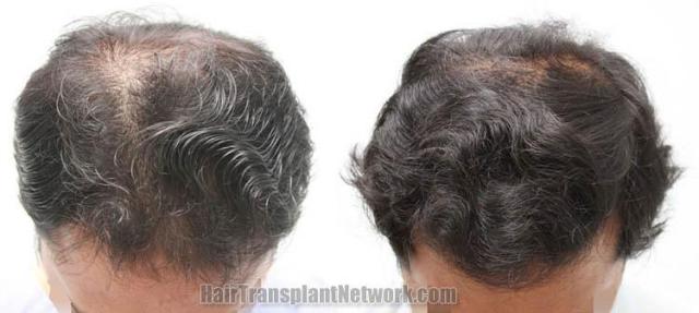 Hair transplantation surgery before and after photos