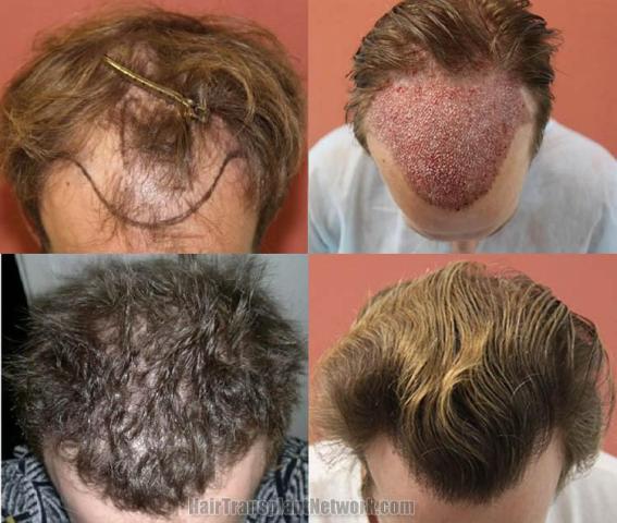 Hair transplantation surgery before and after pictures