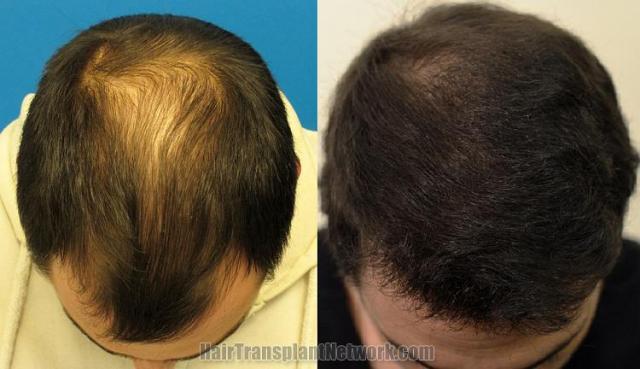 Top view before and after hair restoration results