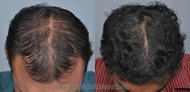 Before and after hair transplant procedure images