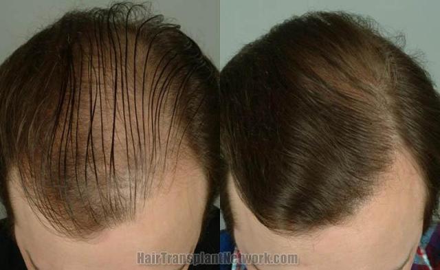 Top view before and after hair restoration results