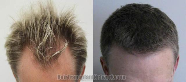 Hair transplantation surgery before and after images