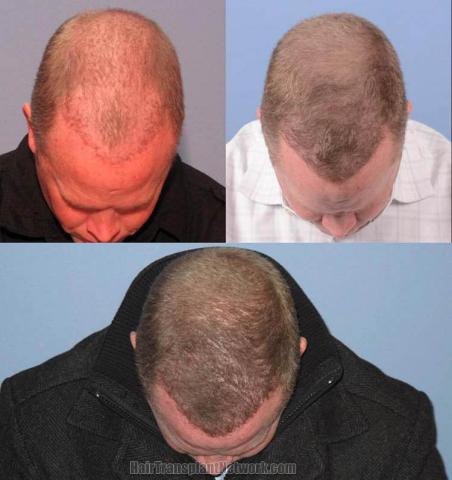 Hair transplantation surgery before and after photos