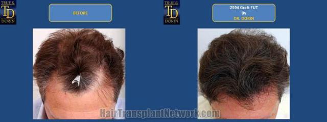 Hair transplantation surgery before and after photos