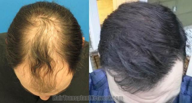 Top view - Before and after surgical hair replacement