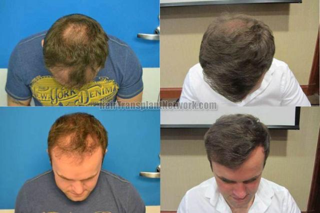 Before and after hair transplant procedure images