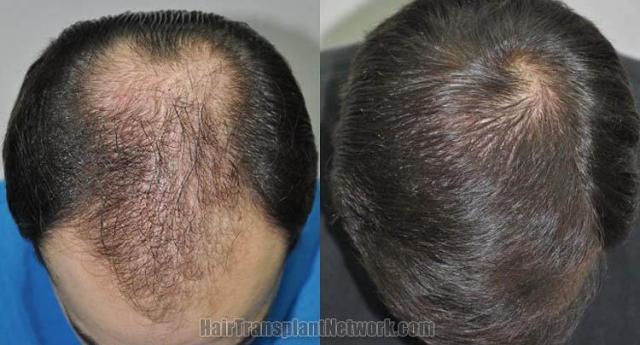 Top view before and after hair restoration results