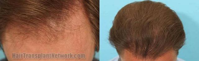 Hair transplantation surgery before and after pictures