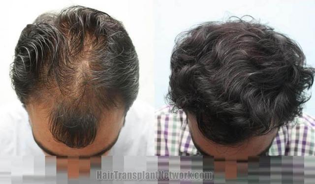 Top view - Before and after surgical hair replacement