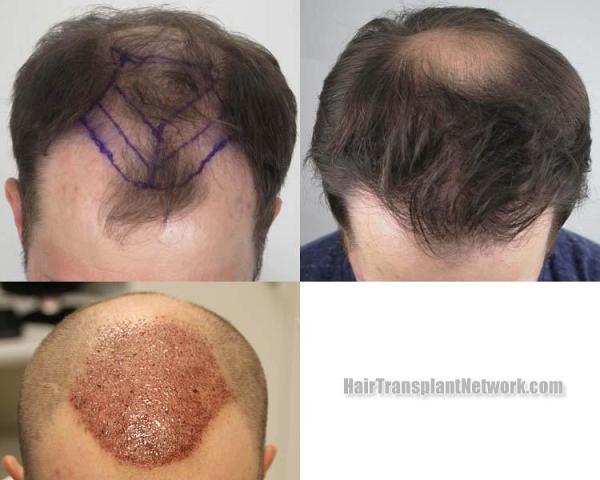 Hair transplantation surgery before and after photos