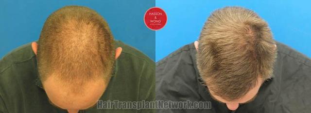 Hair transplantation surgery before and after photos