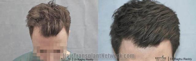 Top view - Before and after surgical hair replacement