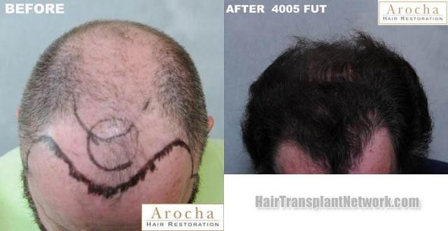 Top view - Before and after surgical hair replacement