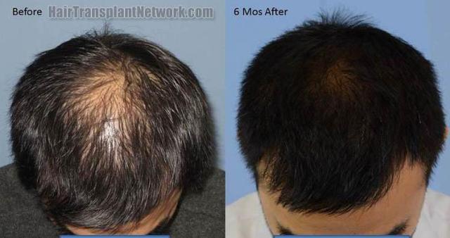 Hair restoration procedure before and after results