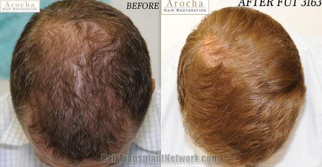 Top view before and after hair restoration results