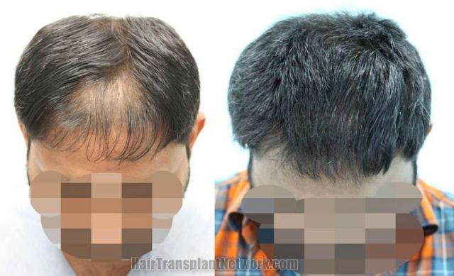 Hair transplantation surgery before and after images