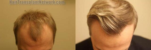 Top view - Before and after surgical hair replacement