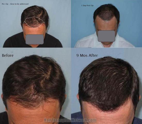 Hair transplantation surgery before and after photos