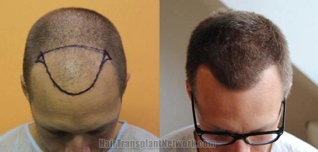 Hair transplantation surgery before and after photos