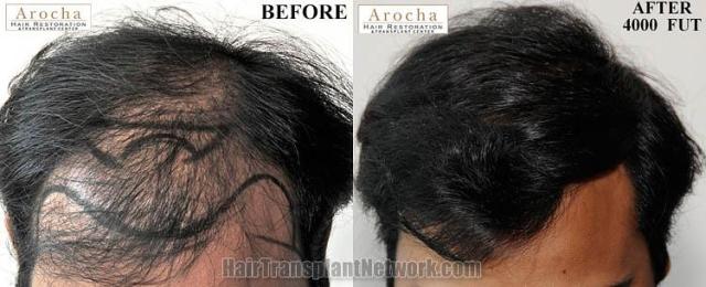 Hair restoration procedure before and after results