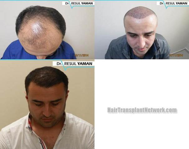 Hair restoration procedure before and after results