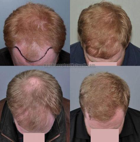 Hair transplantation surgery before and after photos