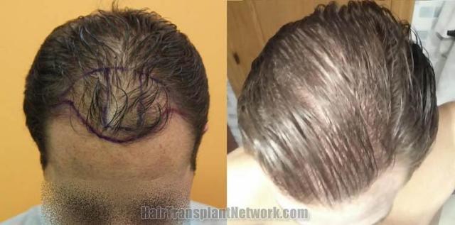 Hair transplantation surgery before and after photos