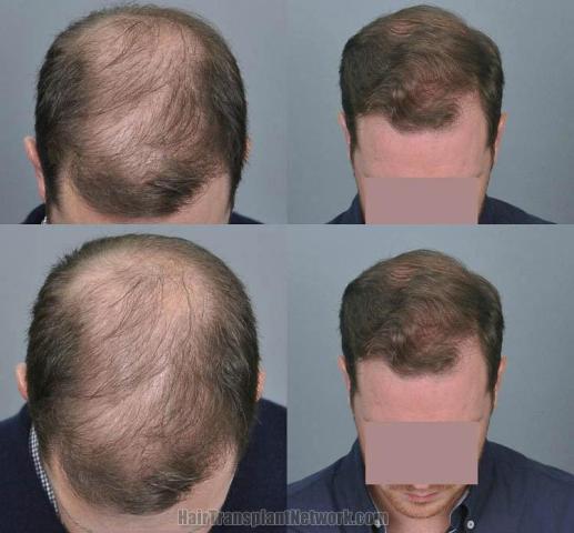 Hair transplantation surgery before and after photos