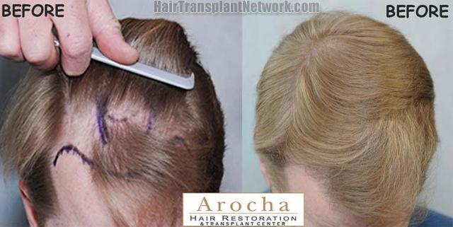 Hair restoration procedure before and after results