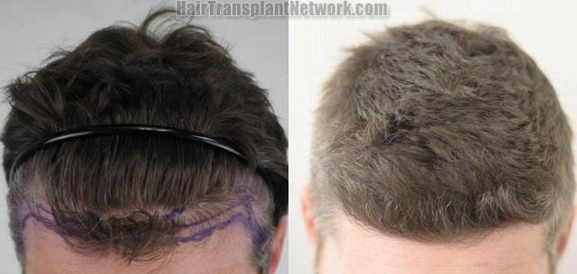 Hair transplantation surgery before and after photos