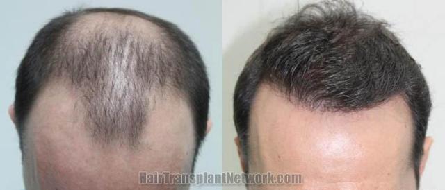 Hair restoration procedure before and after results