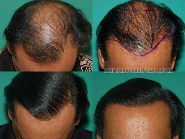 Before and after hair restoration procedure images