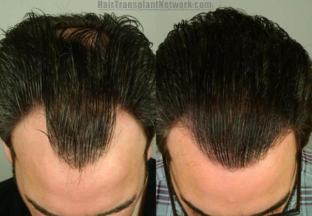 Hair restoration procedure before and after photo results