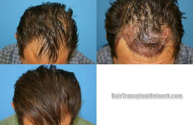 Before and after hair transplant procedure images