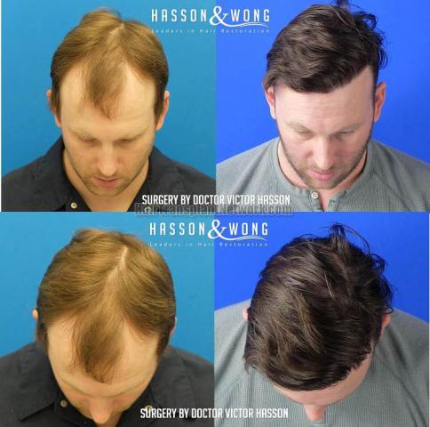 Hair transplantation surgery before and after images