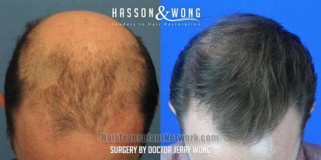 Hair transplantation surgery before and after images