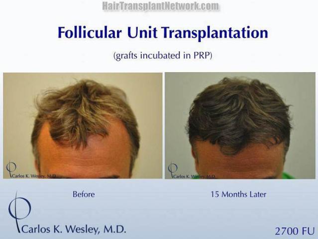 Top view - Before and after surgical hair replacement