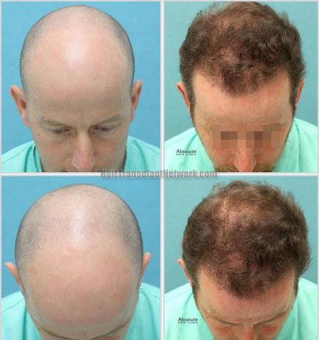 Top view before and after hair restoration results