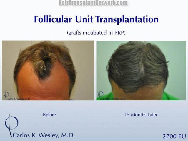 Surgical hair transplantation result photographs