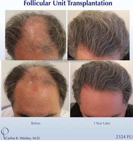 Hair transplantation surgery before and after images